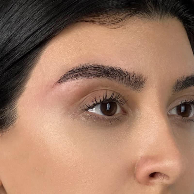 after-eyebrow-lifting