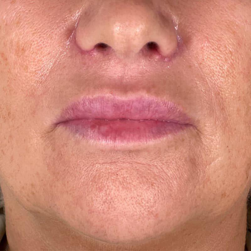 nostril-treatment