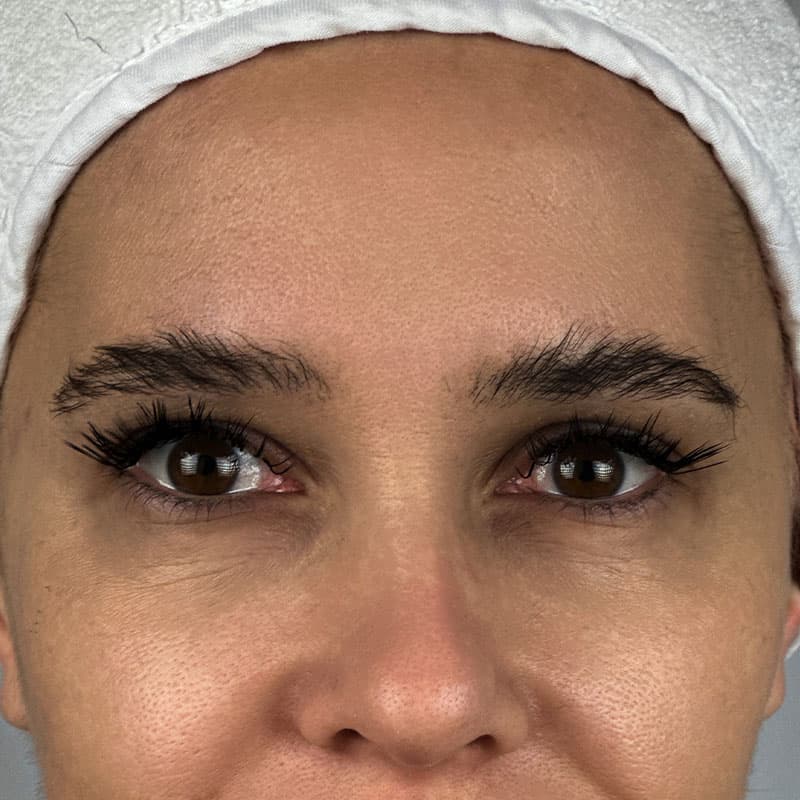 before-brow-lifting-women