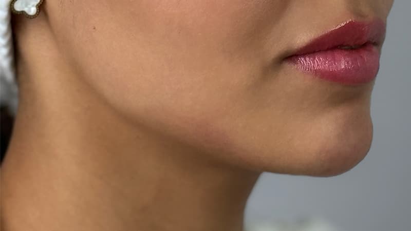 jawline-lady-after