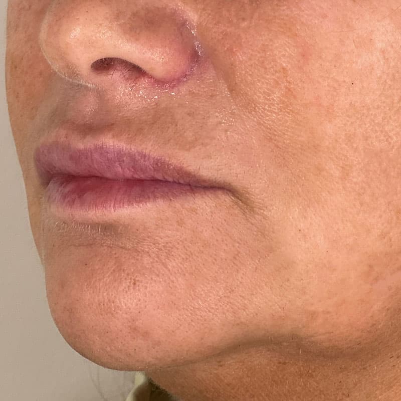 nostril-after-treatment