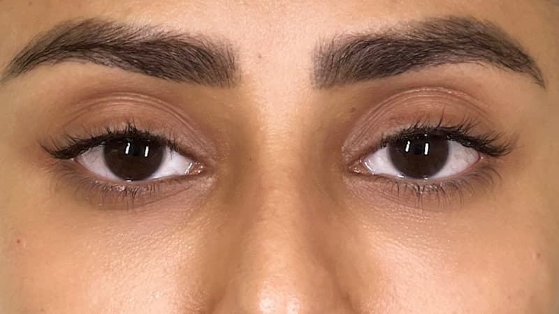 dark-circles-treatments