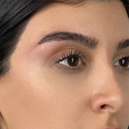 after-brow-nonsurgical-treatment
