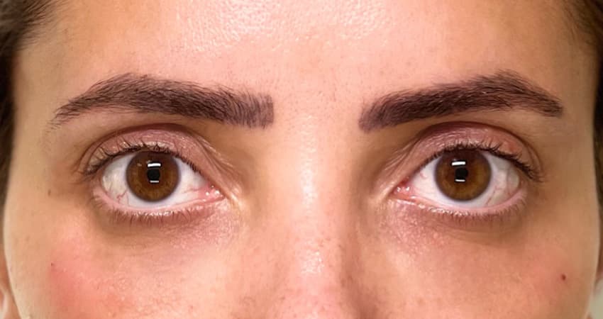 under-eye-dermalfillers