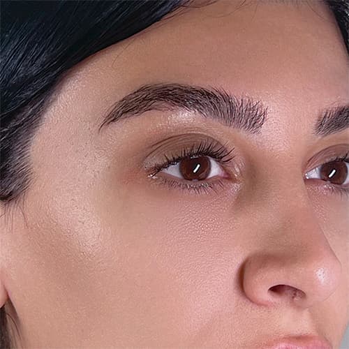 nonsurgicalbrow-lift
