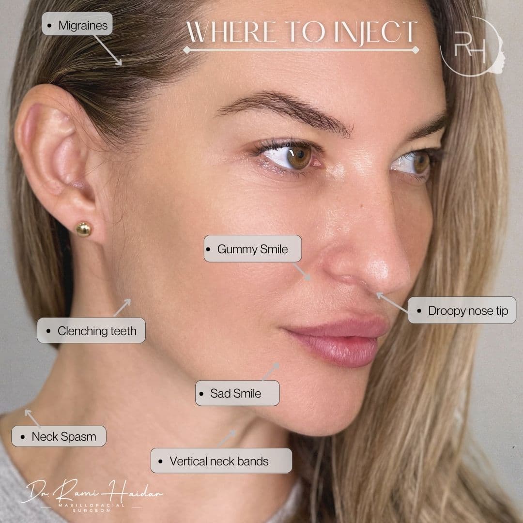 where-to-inject-botox