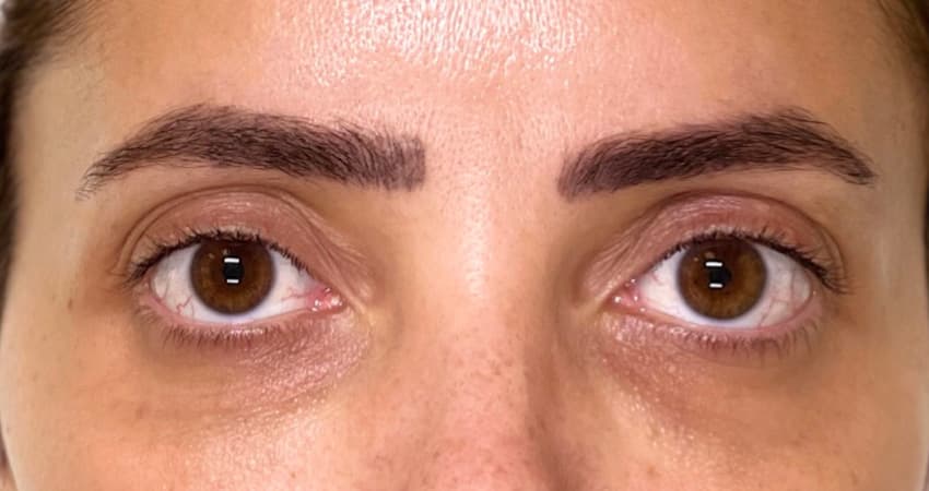 undereyes-dermal-fillers