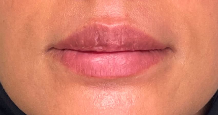 lip-reshaping-dubai-1