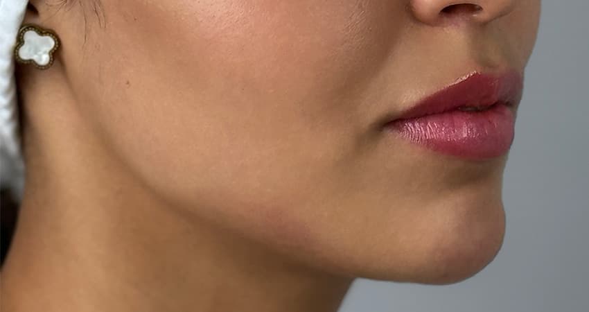 jawline-fillers-after