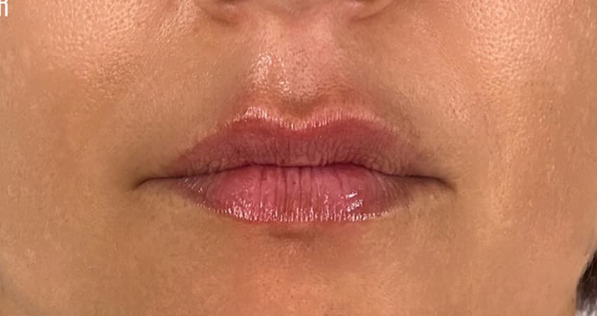 lips-before-after-today