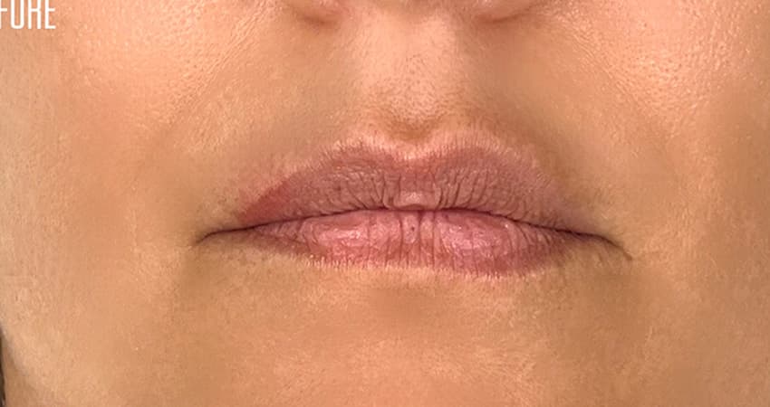 dubai-wrinkled-lips