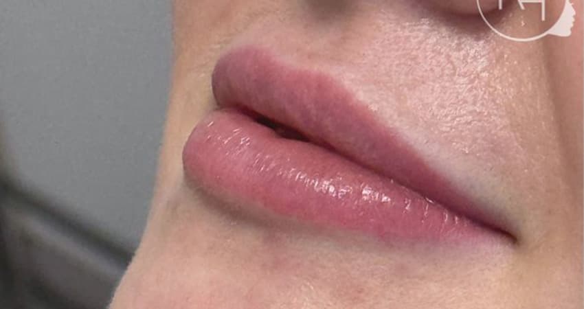 lipfillers-before-dubai