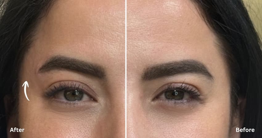 brow-lift-filler-dubai