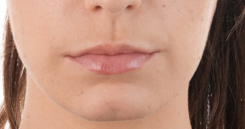 before-lips-filler-dubai