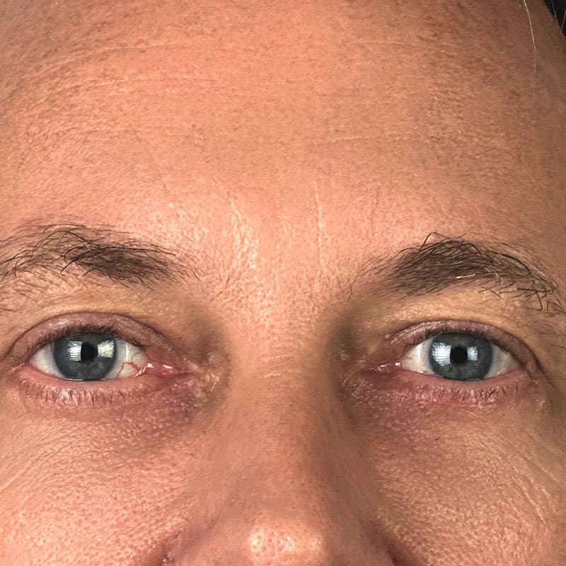 male-treatment-brows