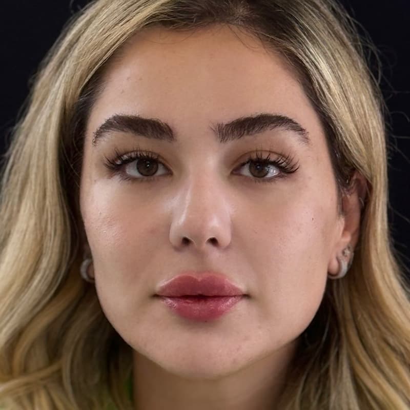 signature-treatments-fillers