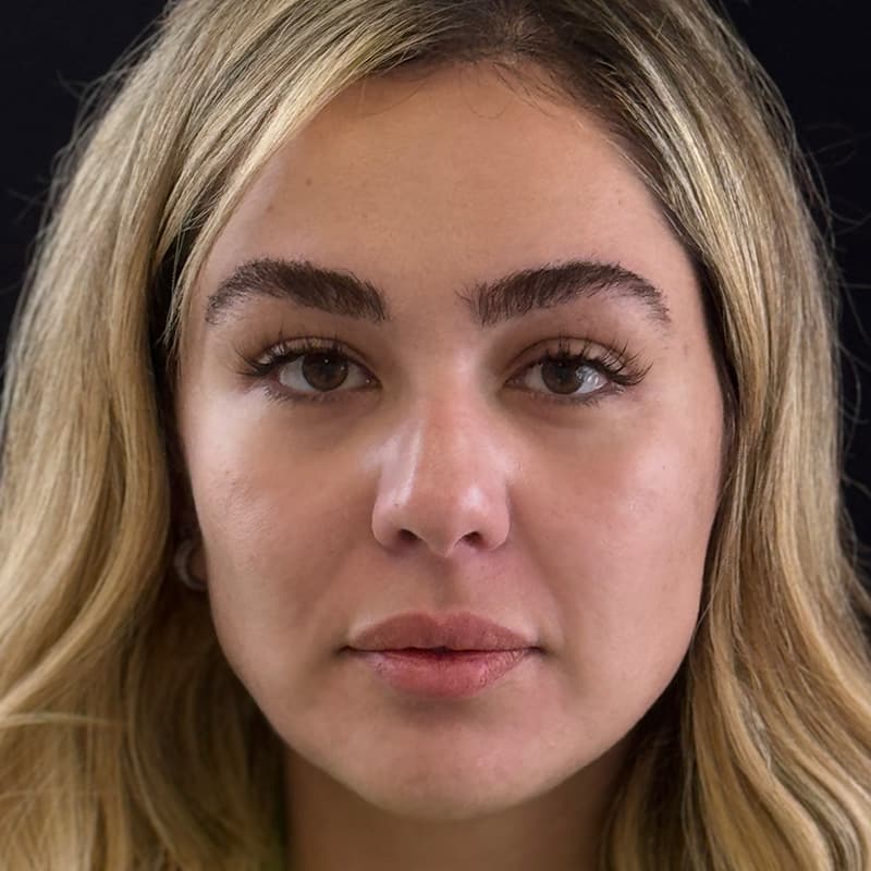 dermal-fillers-before