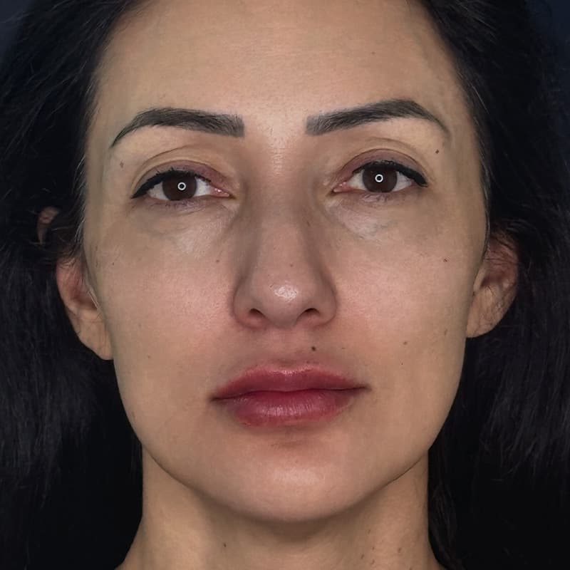 dermal-fillers-after