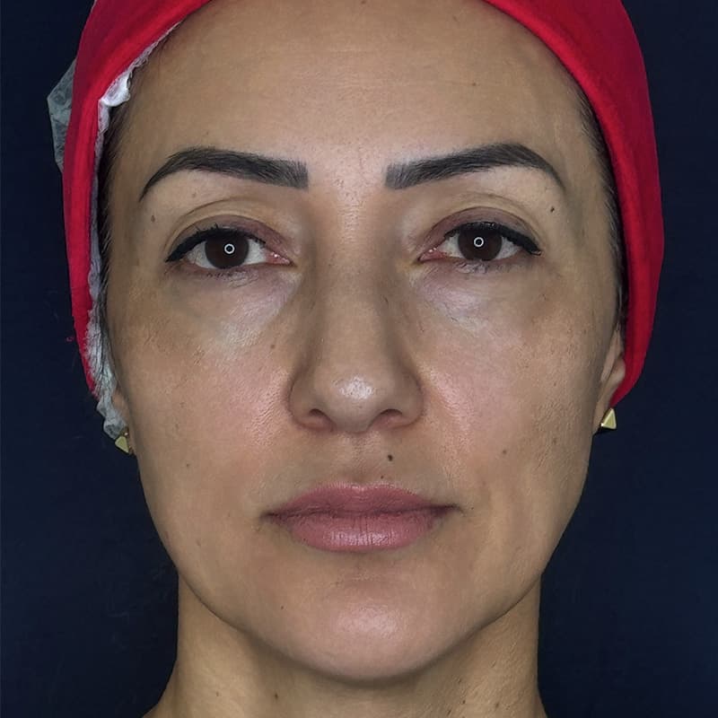 ha-fillers-before