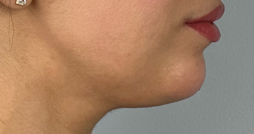 chin-filler-after