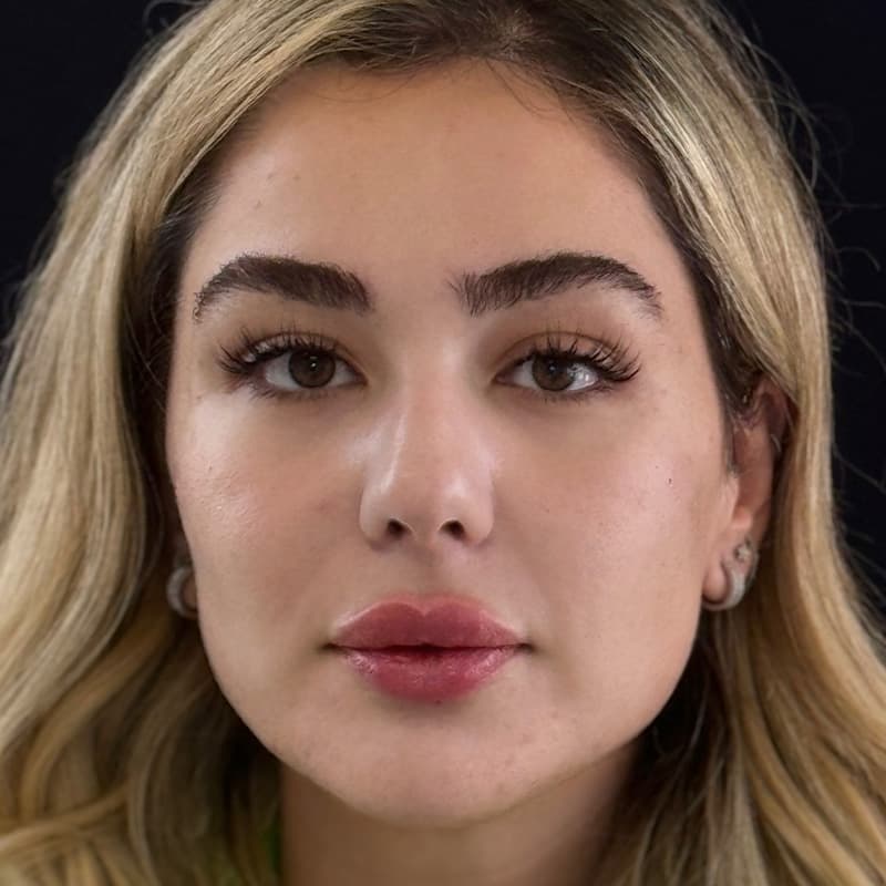 skin-boosters-fillers