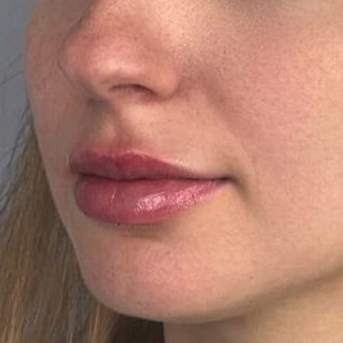lips-after-filler