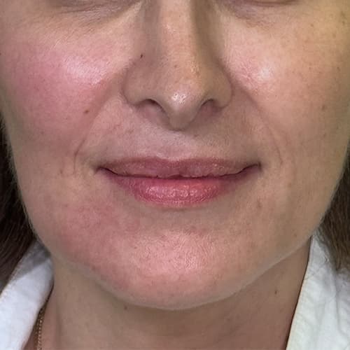 Rf-skin-tightening-after