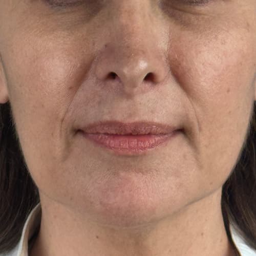 rf-skin-tightening-before
