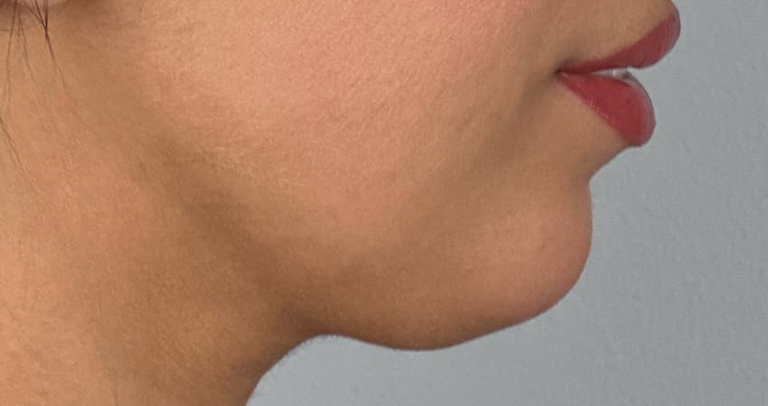 chin-fillers-before