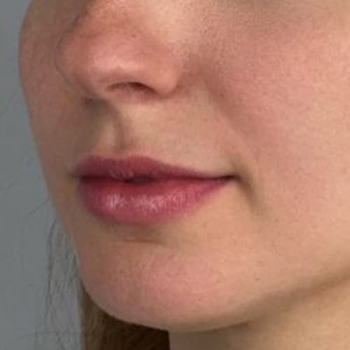 lip-before-fillers