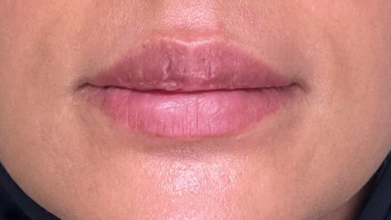 lip-reshape-after