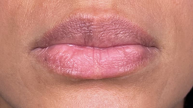 lip-reshaping-before