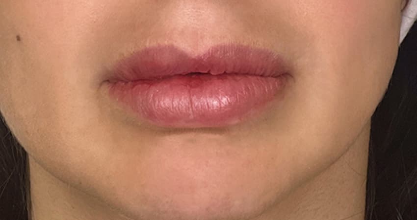 lip-reshaping-dissolve