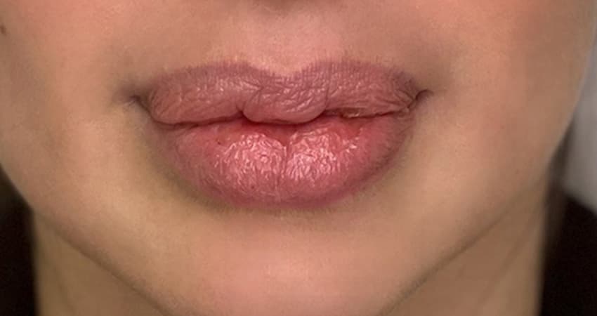 lip-reshaping-dubai-2