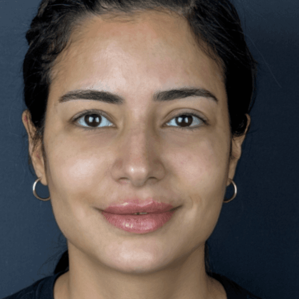 after_facial-harmonisation